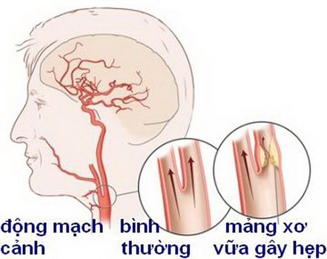 Nguyên nhân chính gây thiếu máu não