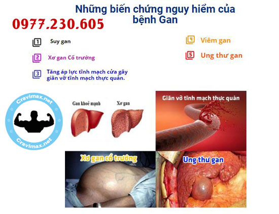 biến chứng viêm gan