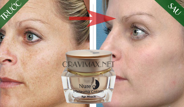 kết quả sau khi dùng kem nure'o melasma cream